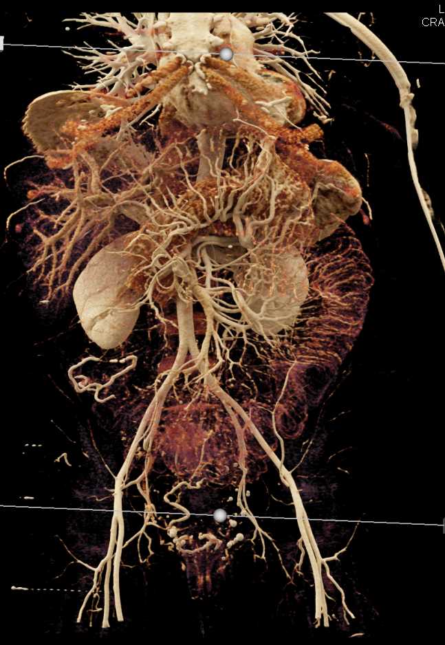 Small Bowel Obstruction with Cinematic Rendering (CR) - CTisus CT Scan