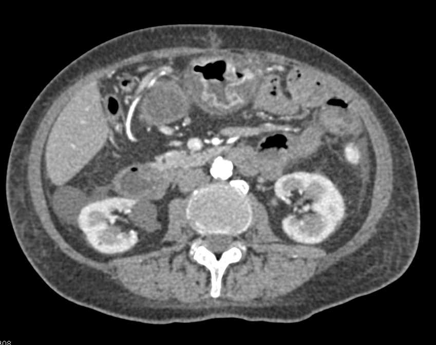 Severe Enteritis Involving the Small Bowel - CTisus CT Scan