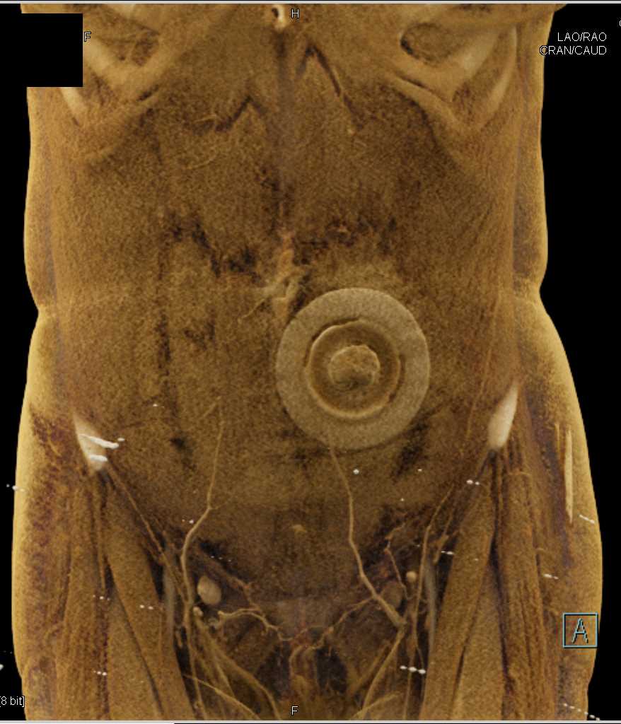 Osteomy in the Left Lower Quadrant - CTisus CT Scan