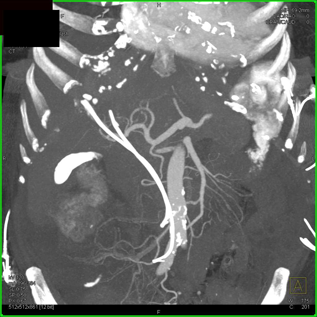 Carcinomatosis and Distal Bowel Obstruction - CTisus CT Scan