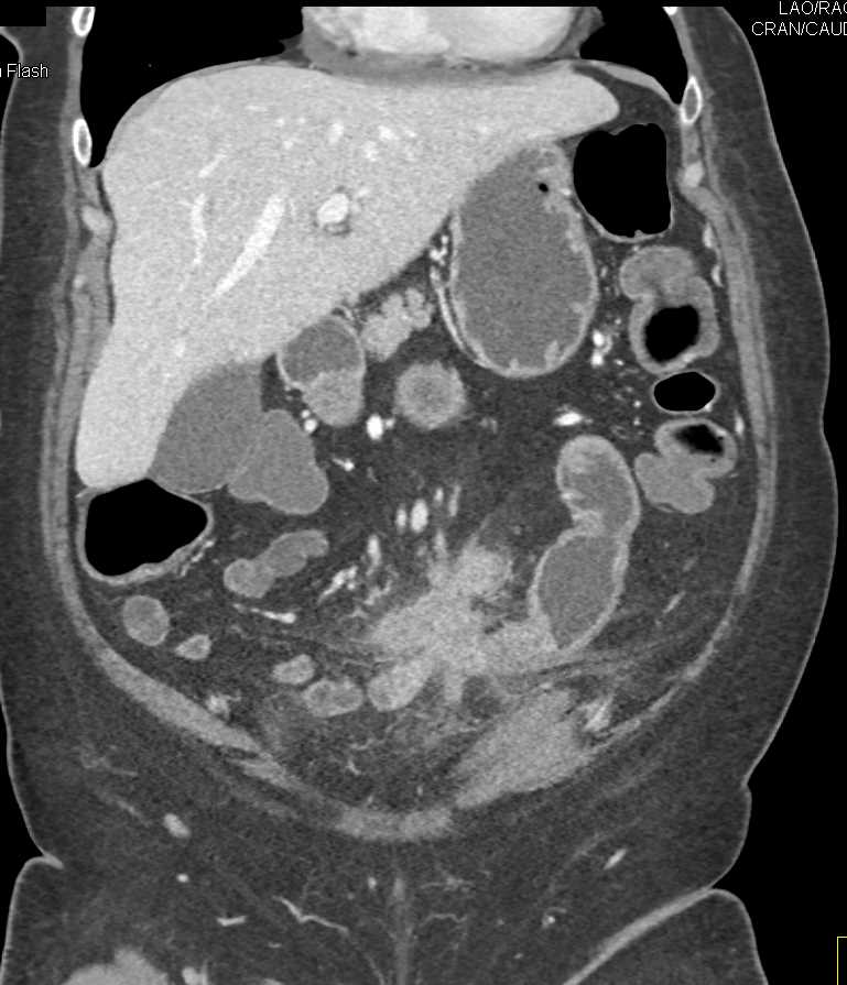 Carcinoid Tumor with Desmoplastic Reaction - CTisus CT Scan