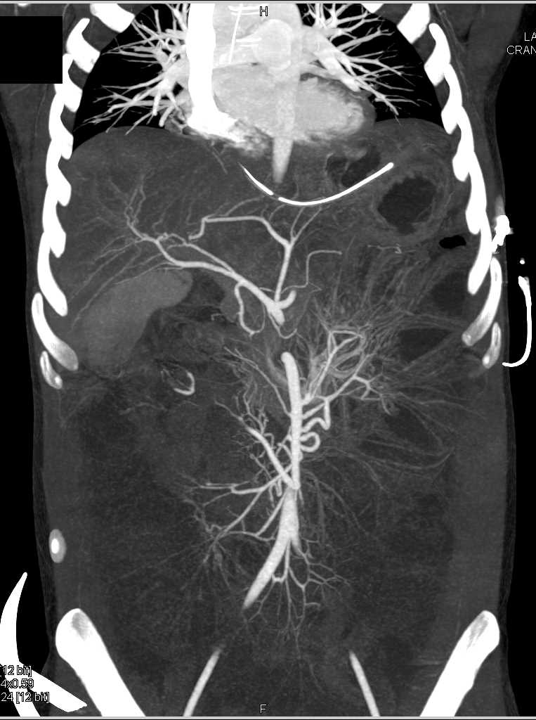 Small Bowel Obstruction - CTisus CT Scan