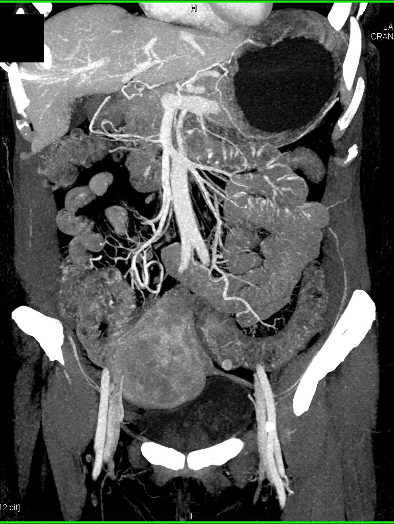 Angiodysplasias Proximal Small Bowel - CTisus CT Scan