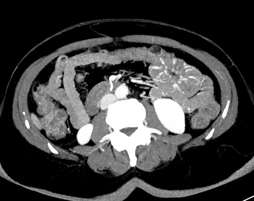Angiodysplasias Proximal Small Bowel - CTisus CT Scan