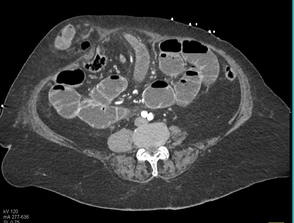 Small Bowel Obstruction (SBO) with Hernia in the Abdominal Wall - CTisus CT Scan