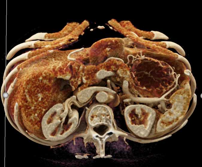 Cinematic Rendering (CR) Small Bowel and Mesentery - CTisus CT Scan