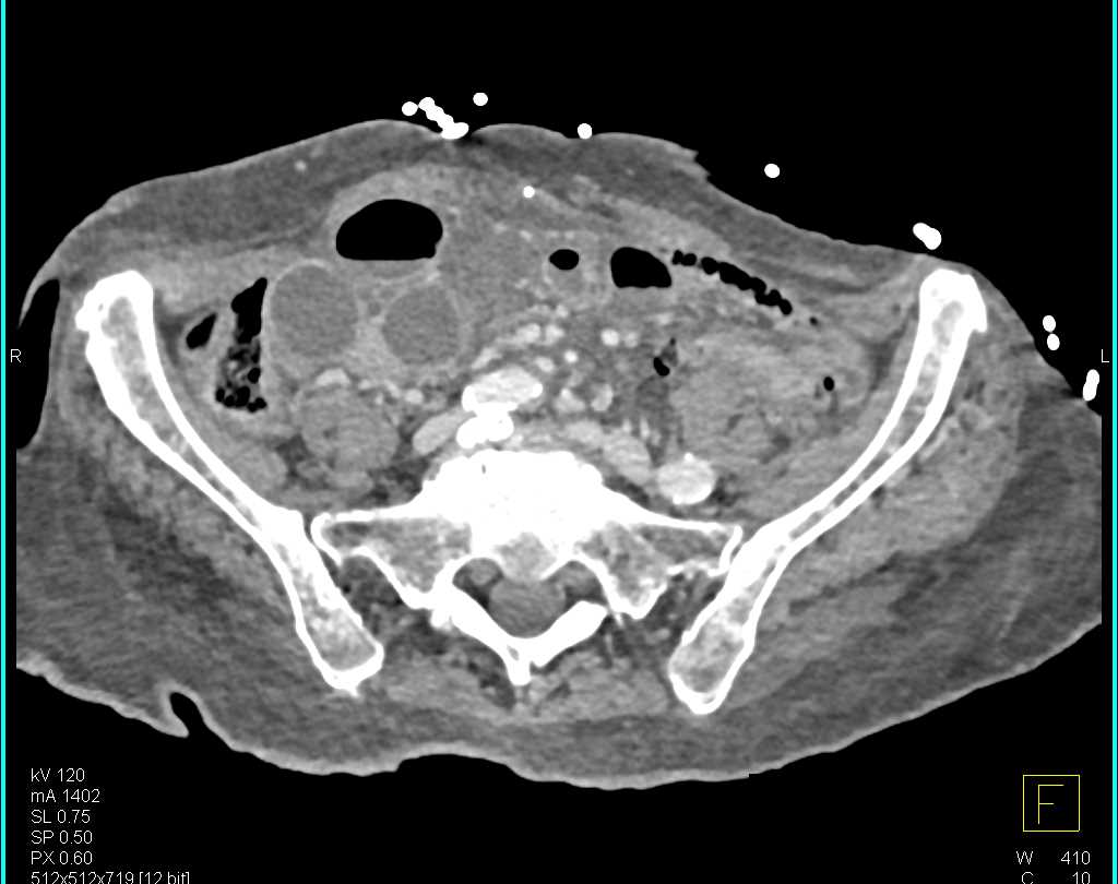 Small Bowel Obstruction (SBO) with Internal Hernia - CTisus CT Scan