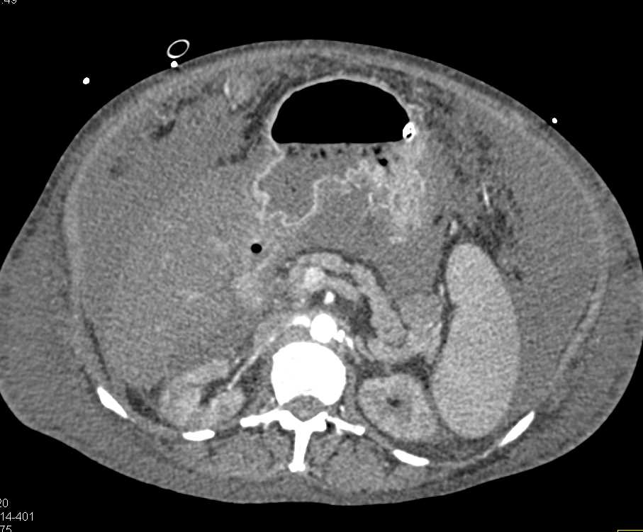 Hypotensive Patient with Ascites , Poor Renal Function and Small Caliber Superior Mesenteric Artery (SMA) and Celiac - CTisus CT Scan