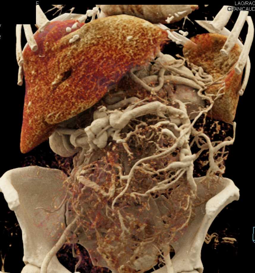 Large GIST Tumor with Neovascularity - CTisus CT Scan