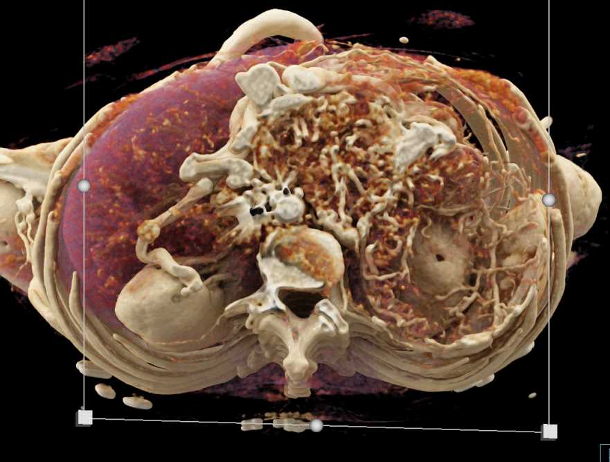 Large GIST Tumor with Neovascularity - CTisus CT Scan