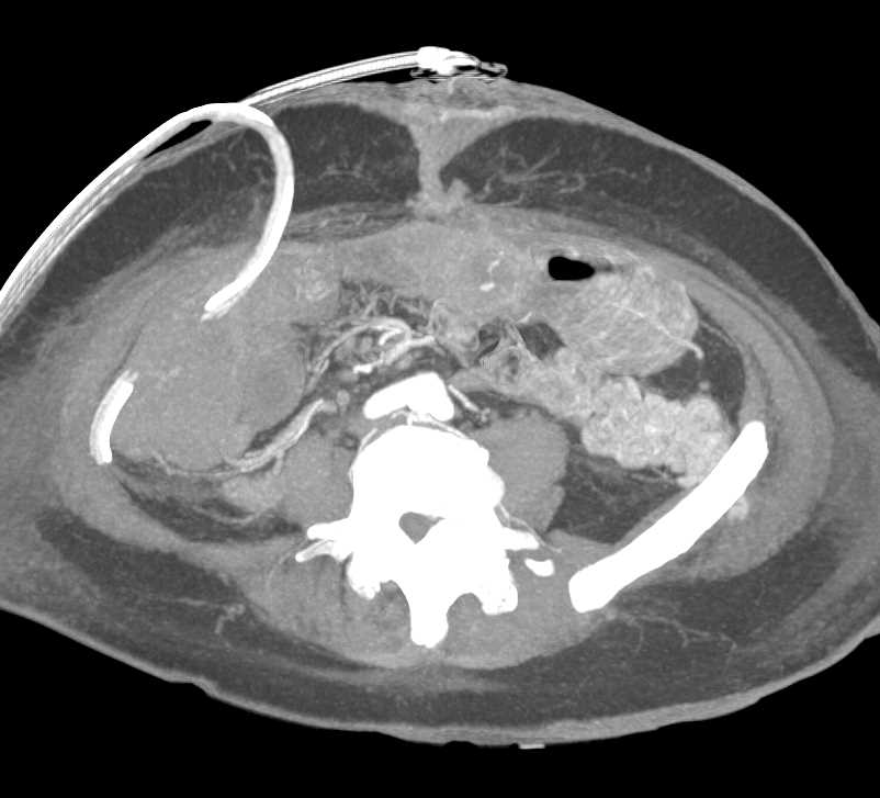 Active Bleed in a Gastrojejunostomy - CTisus CT Scan