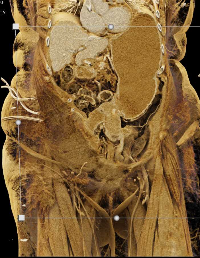 Active Bleed in a Gastrojejunostomy - CTisus CT Scan