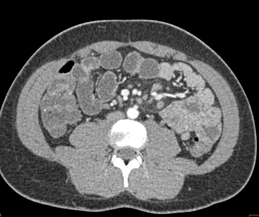 Mesenteric Nodes due to MAI Infection - CTisus CT Scan