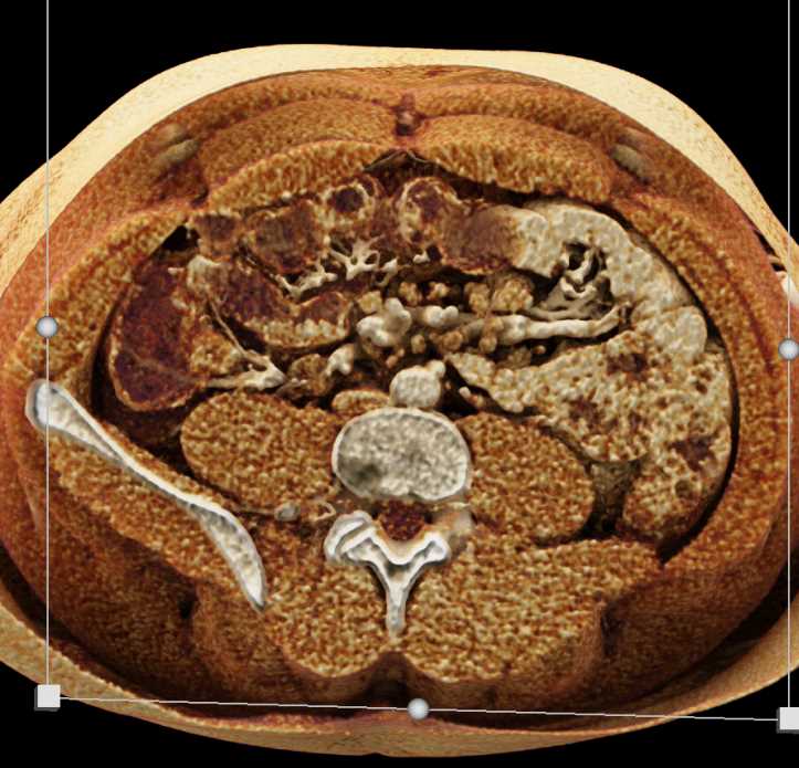Mesenteric Nodes due to MAI Infection - CTisus CT Scan