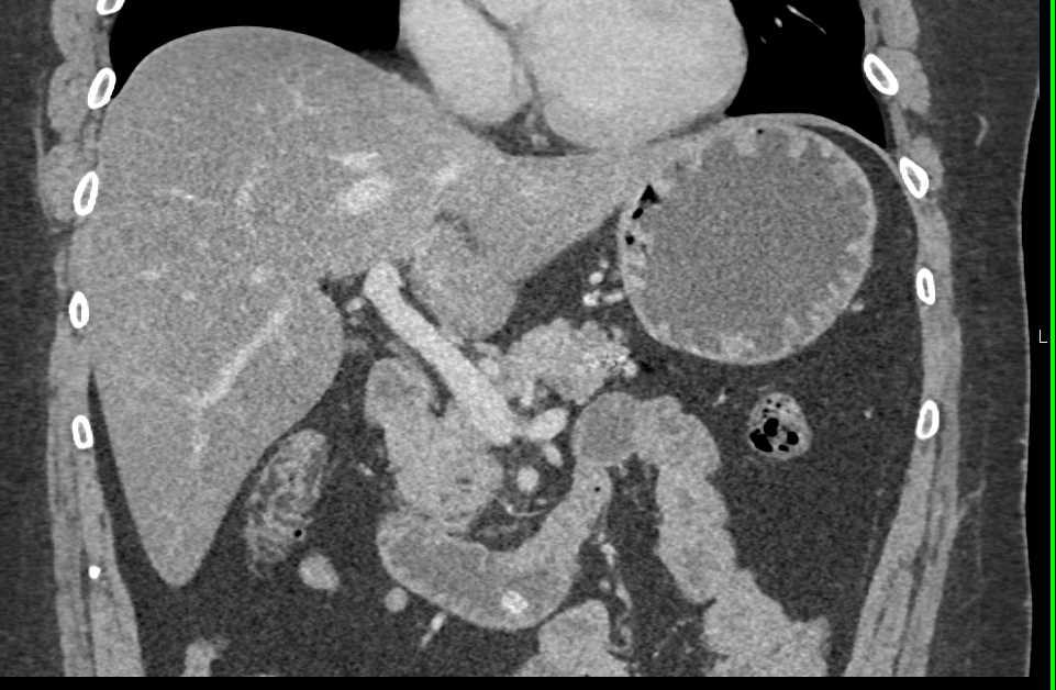 Active Bleed in 4th Portion Duodenum - CTisus CT Scan