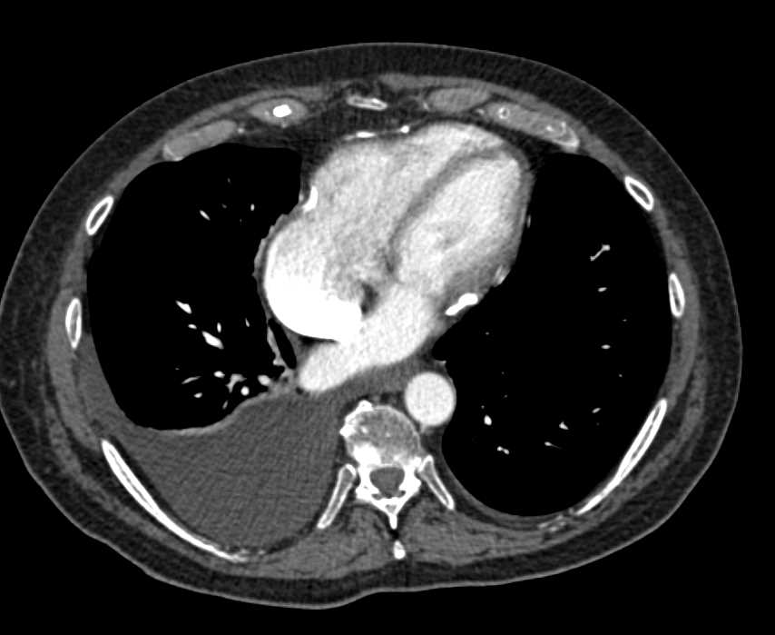 Carcinoid Tumor Duodenum - CTisus CT Scan