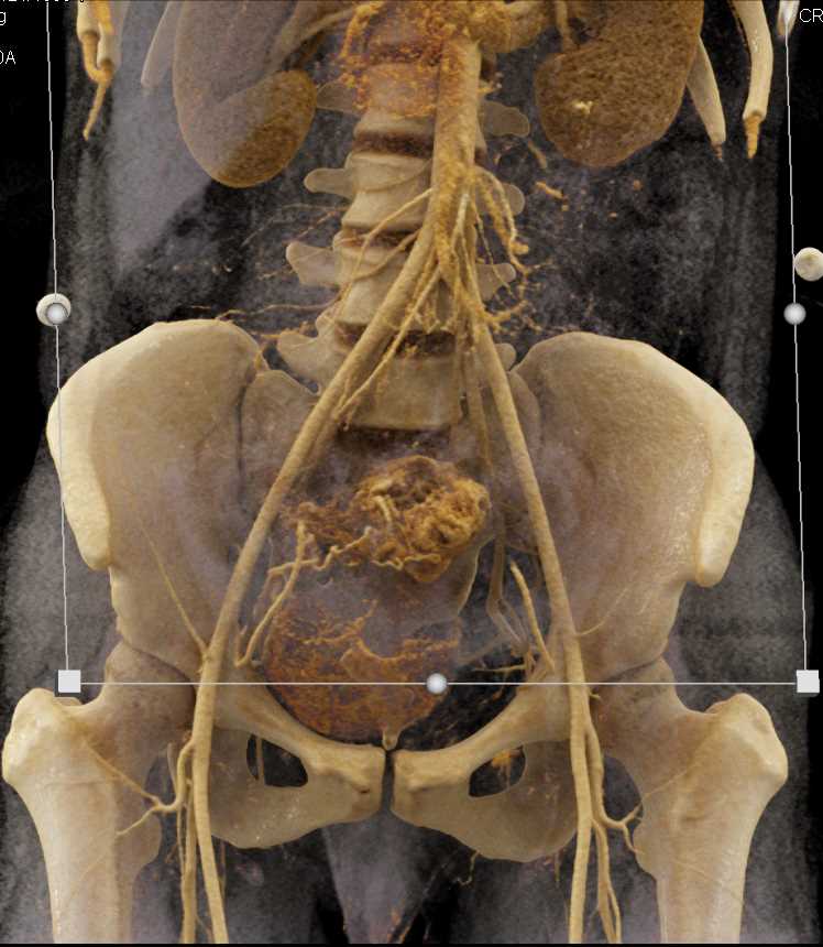 Vascular Mass Involving Small Bowel - CTisus CT Scan