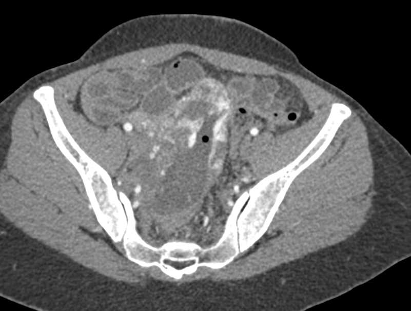 Vascular Mass Involving Small Bowel - CTisus CT Scan