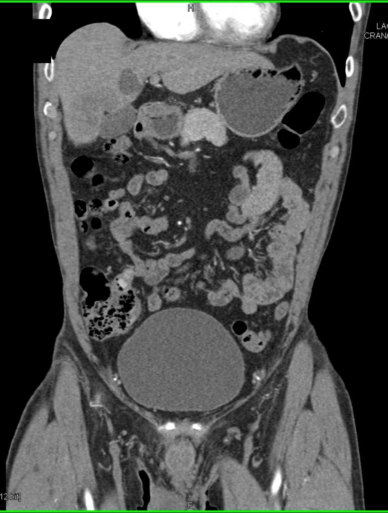 Carcinoid Tumor in Mesentery Right Lower Quadrant - CTisus CT Scan