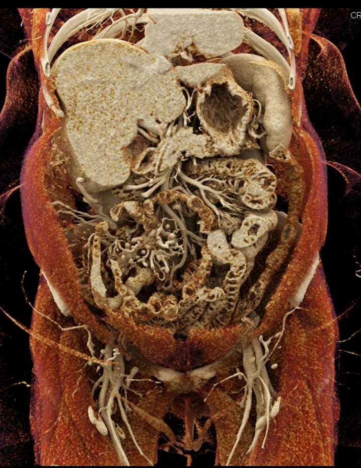 Carcinoid in the Root of the Mesentery - CTisus CT Scan