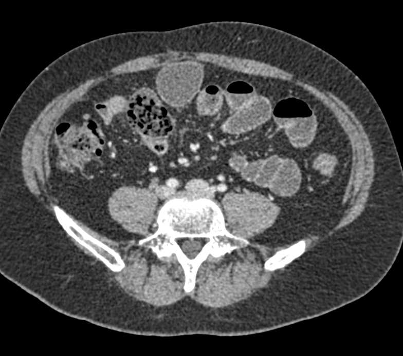 Dilated Small Bowel due to a Small Bowel Stricture - CTisus CT Scan