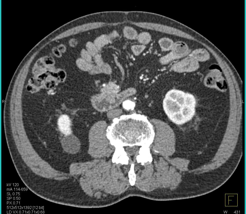 Carcinoid Tumor Encases the Superior Mesenteric Vein (SMV) - CTisus CT Scan