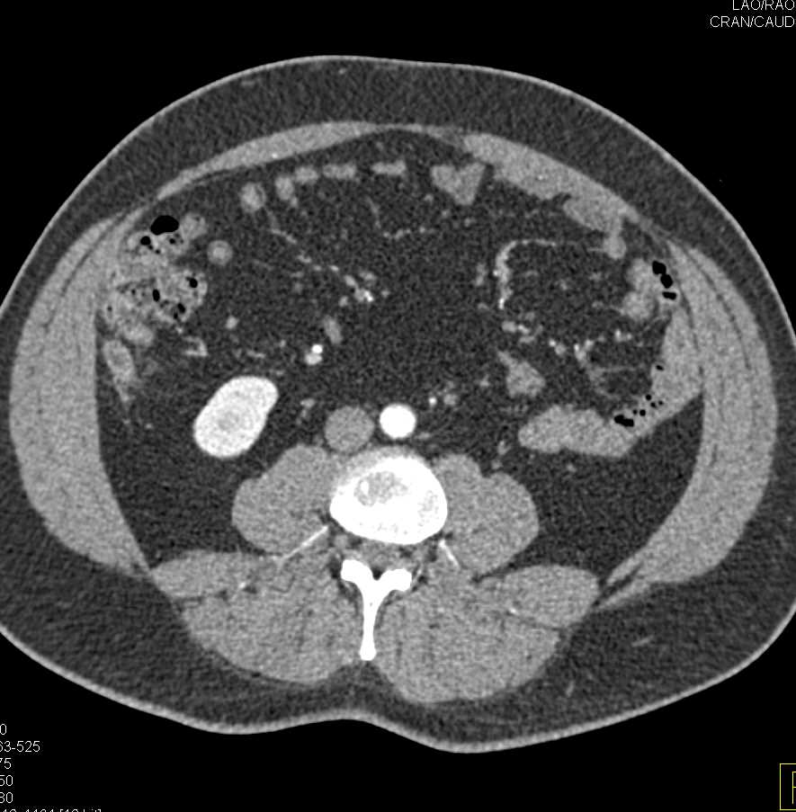 Crohn's Disease - CTisus CT Scan