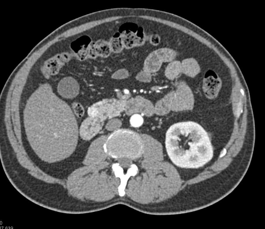 Carcinoid Tumor Duodenum - CTisus CT Scan