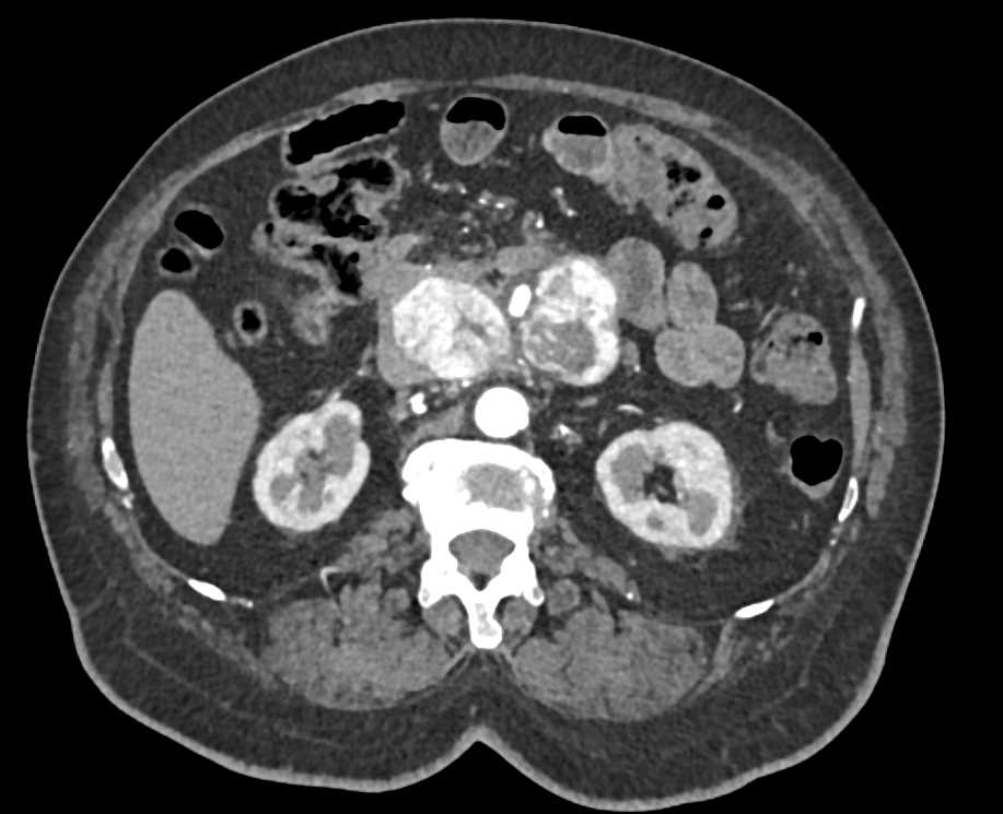 Neuroendocrine Tumor - CTisus CT Scan
