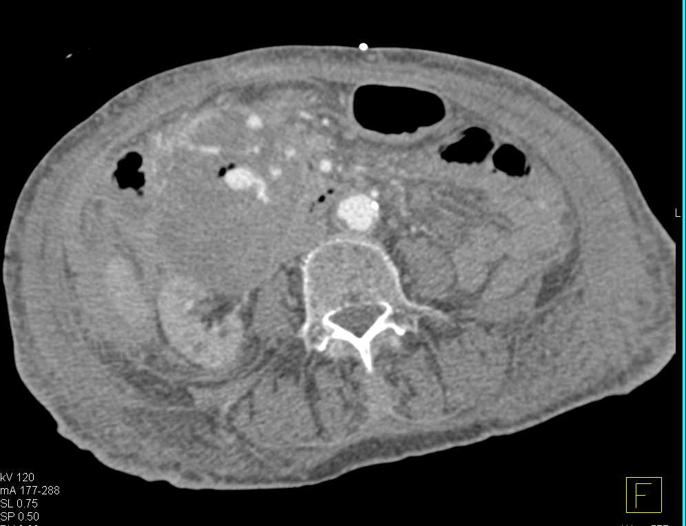 Active Bleed in a Duodenal GIST Tumor - CTisus CT Scan