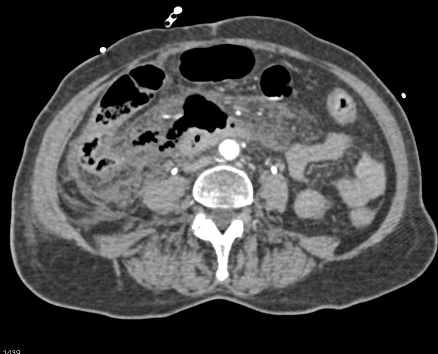 Perforated Small Bowel with Abscess - CTisus CT Scan