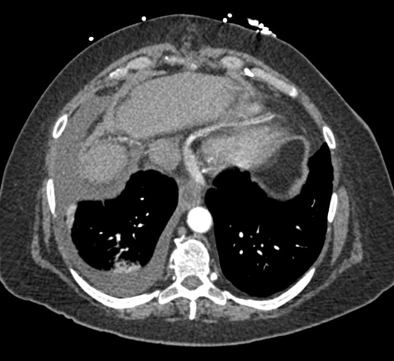 Dilated Small Bowel due to Adhesions - CTisus CT Scan