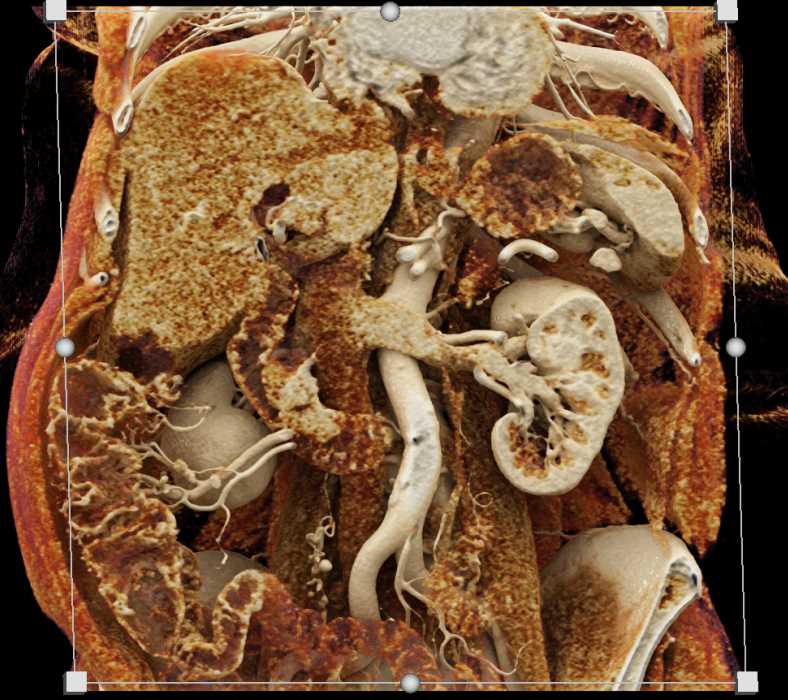 Duodenal Carcinoma Extends to Ampulla - CTisus CT Scan