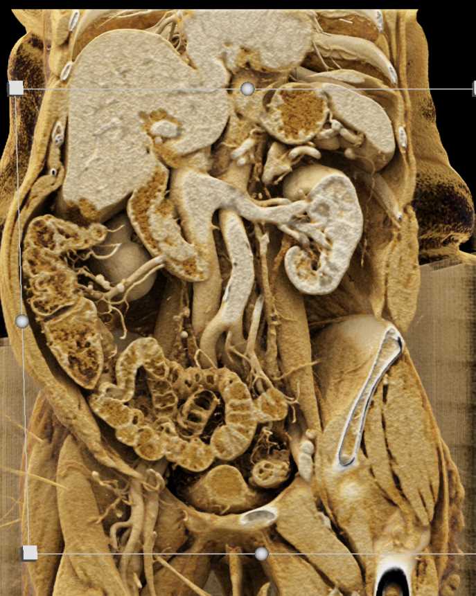 Duodenal Carcinoma Extends to Ampulla - CTisus CT Scan