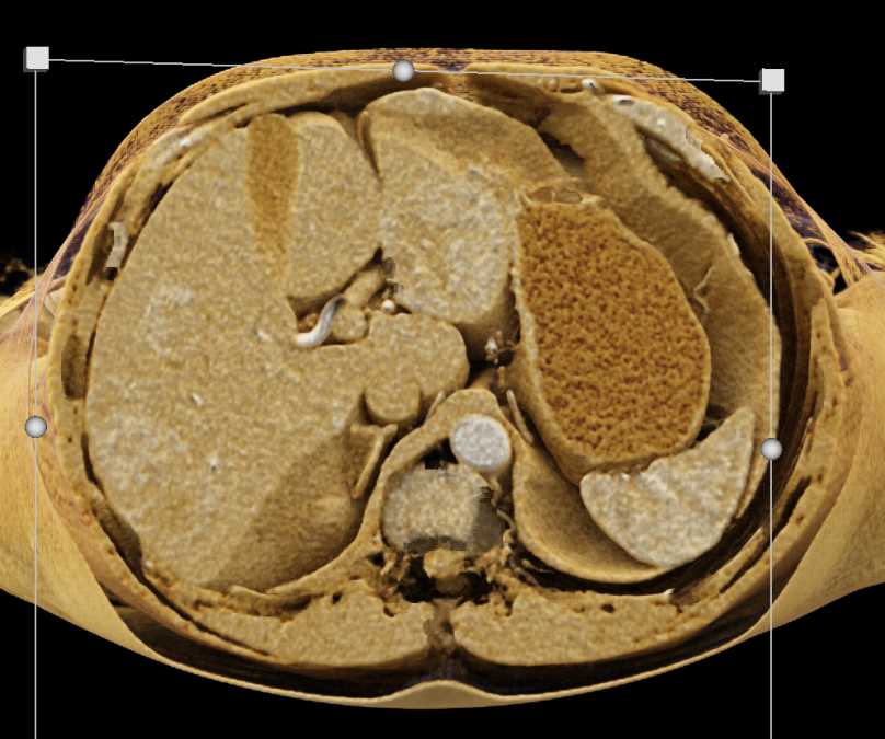 Carcinoid Tumor Root of Mesentery with Liver Metastases using Cinematic Rendering - CTisus CT Scan