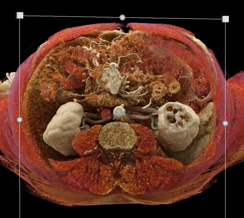 Carcinoid Tumor Root of Mesentery with Liver Metastases using Cinematic Rendering - CTisus CT Scan