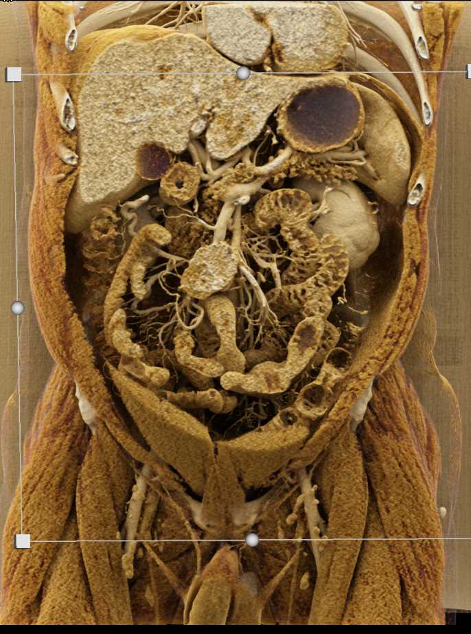 Carcinoid Tumor Root of Mesentery - CTisus CT Scan