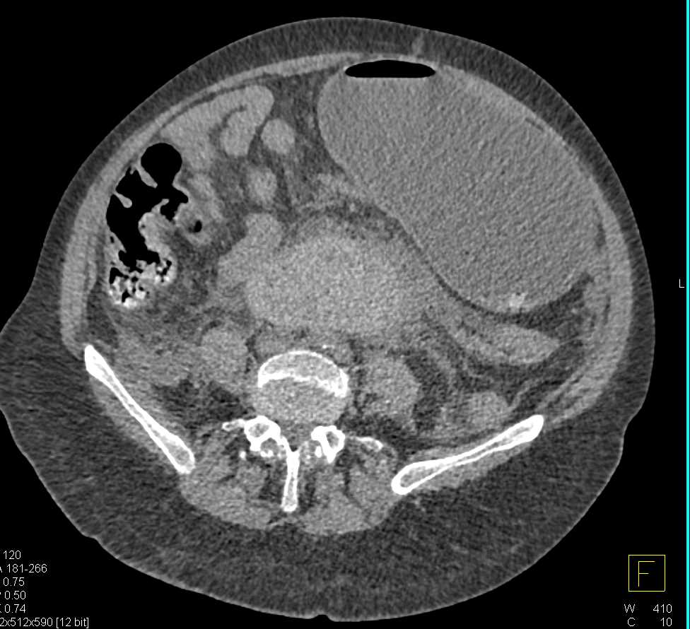 Retroperitoneal Bleed - CTisus CT Scan