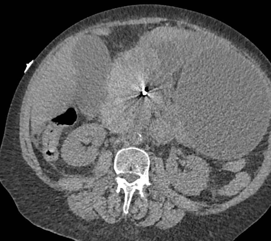 Duodenal Hematoma - CTisus CT Scan