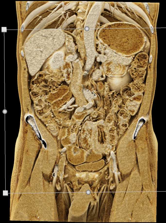 Dilated Small Bowel with Cinematic Rendering - CTisus CT Scan