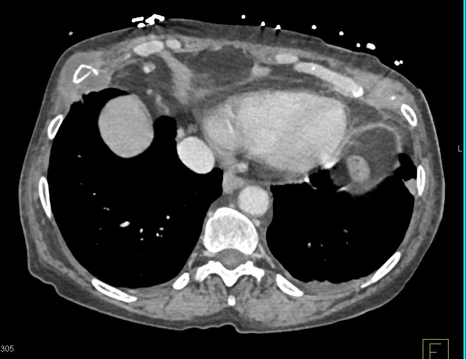 Duodenal Adenocarcinoma with Bone Metastases - CTisus CT Scan