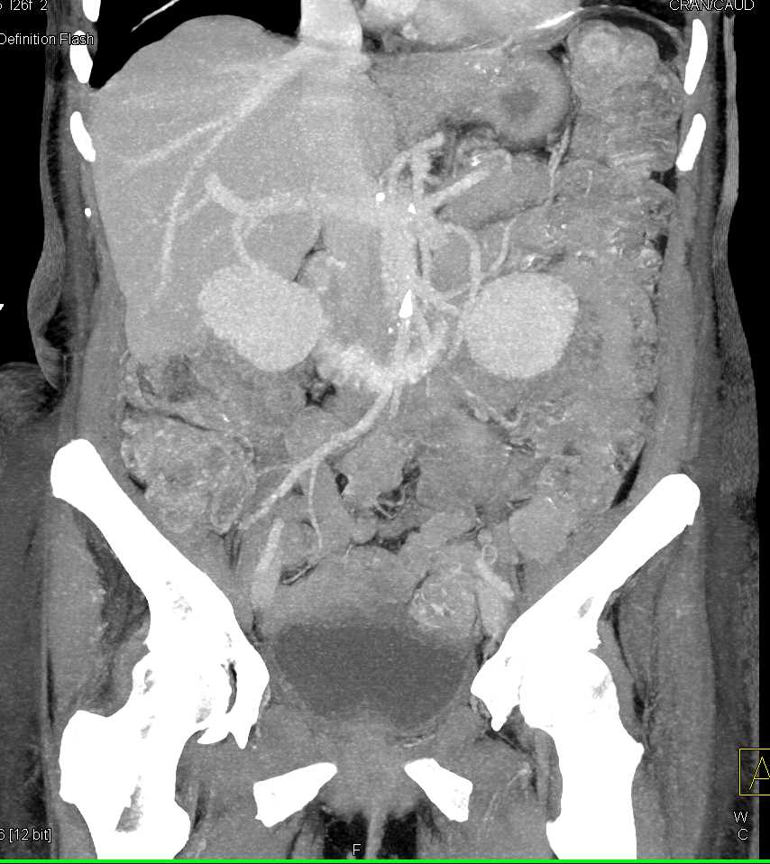 Duodenal Adenocarcinoma with Bone Metastases - CTisus CT Scan