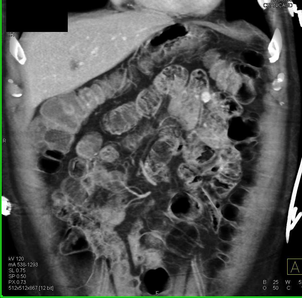 1cm Carcinoid Tumor in the Jejunum - CTisus CT Scan
