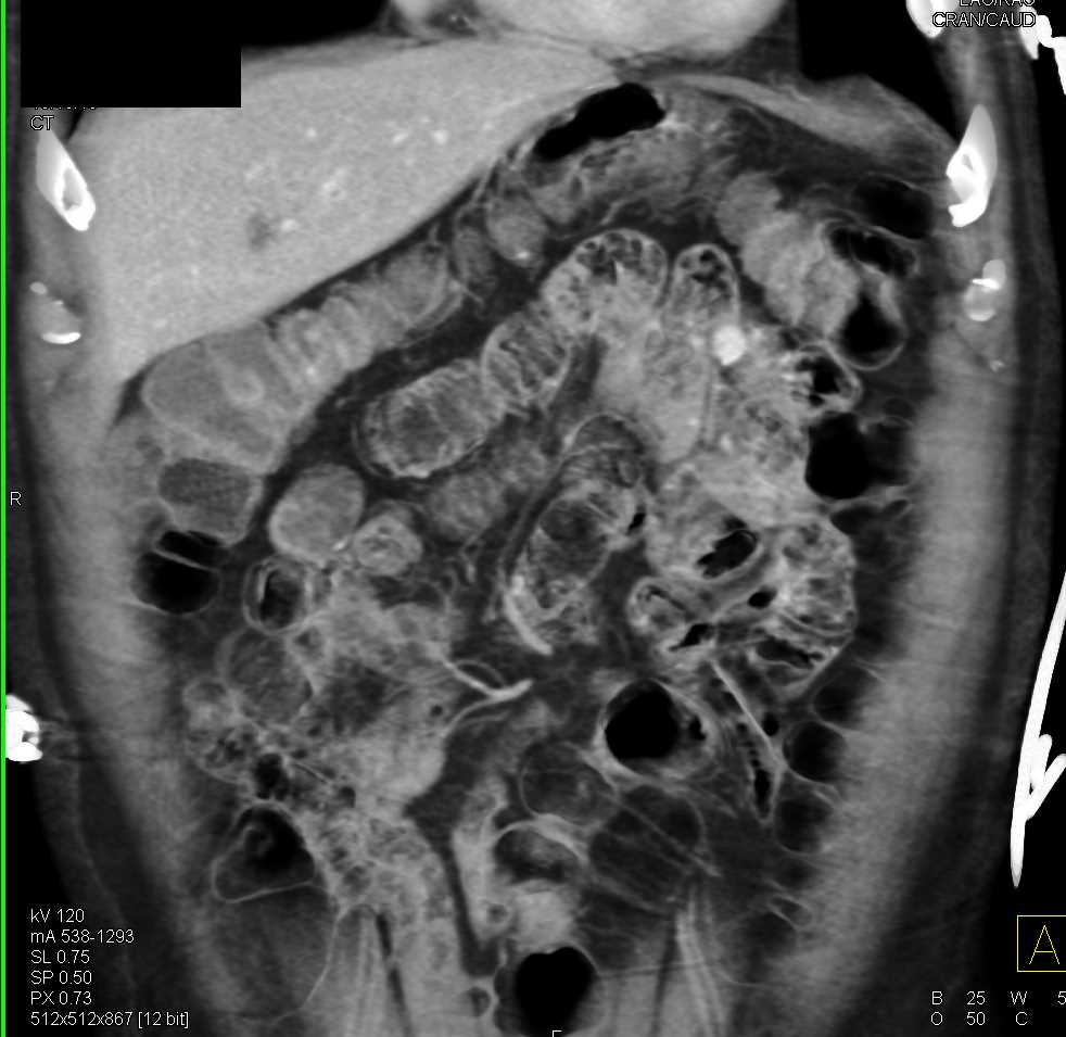 1cm Carcinoid Tumor in the Jejunum - CTisus CT Scan