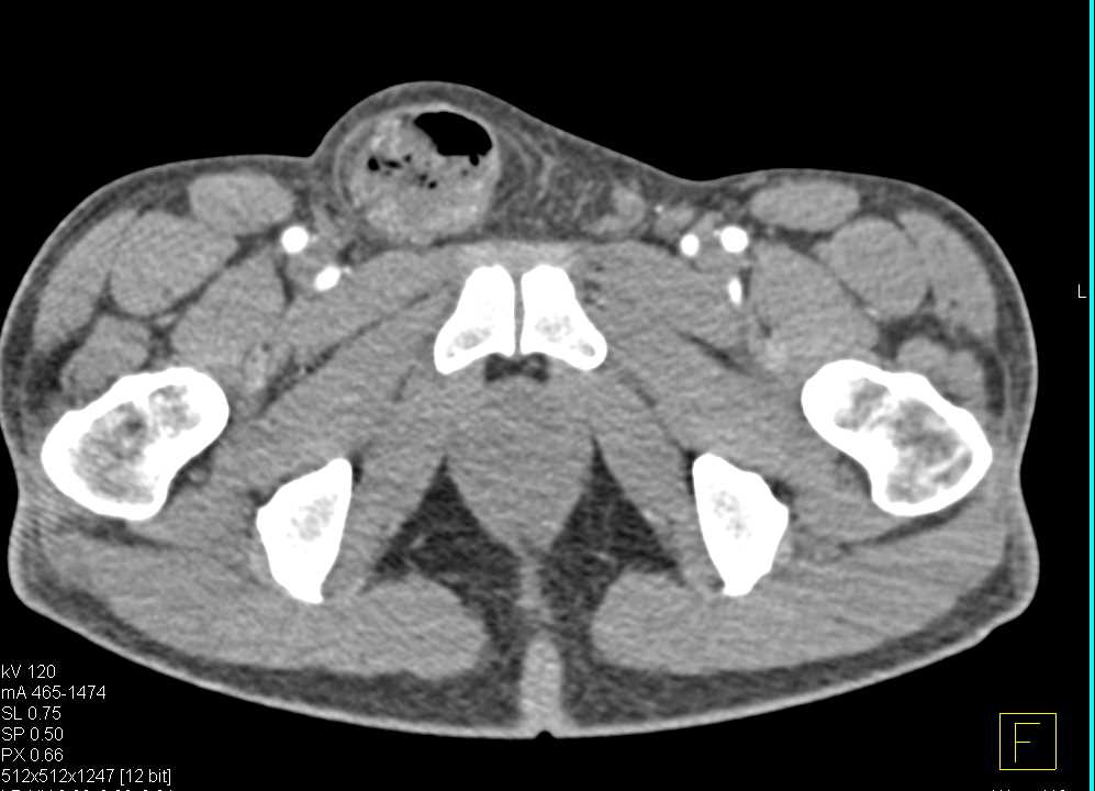 Small Bowel Obstruction (SBO) due to Inguinal Hernia - CTisus CT Scan