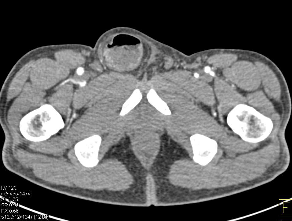 Small Bowel Obstruction (SBO) due to Inguinal Hernia - CTisus CT Scan
