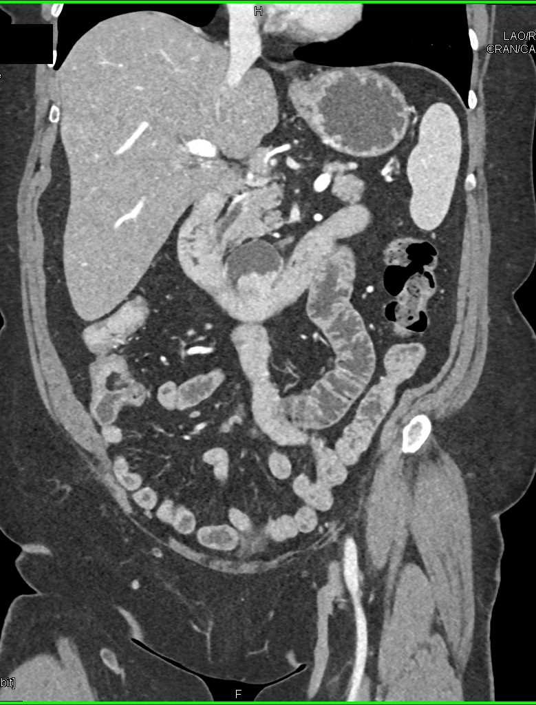 Carcinoma In a Duodenal Diverticulum - CTisus CT Scan