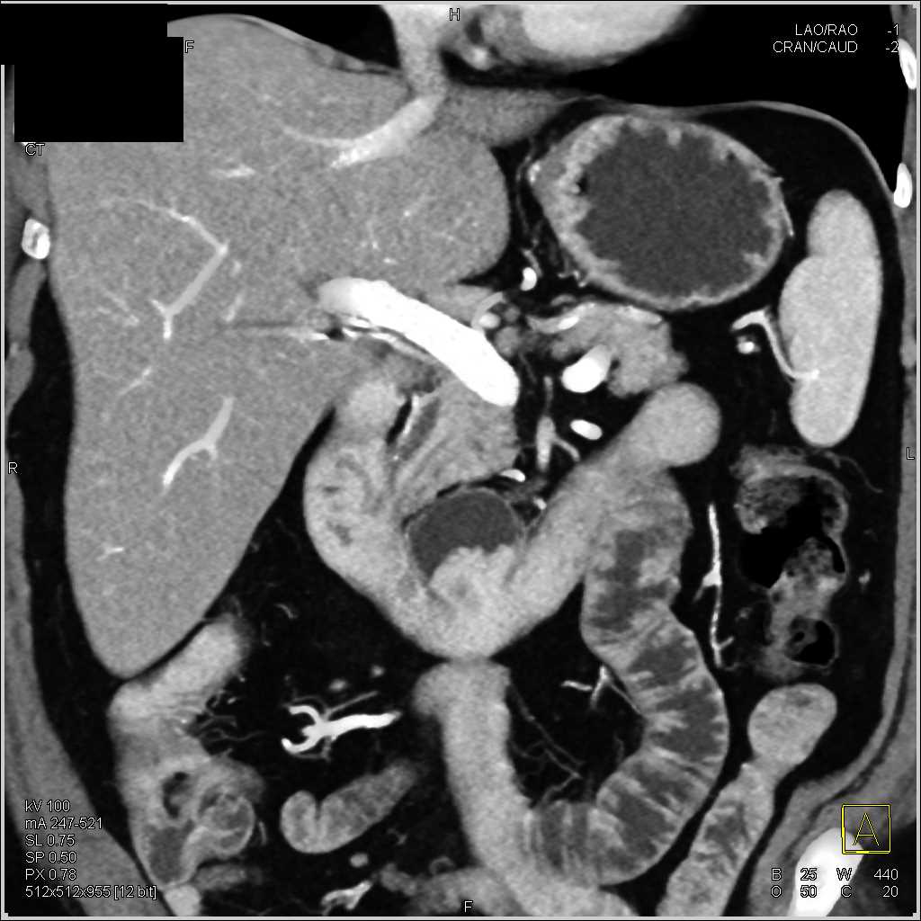 Carcinoma In a Duodenal Diverticulum - CTisus CT Scan