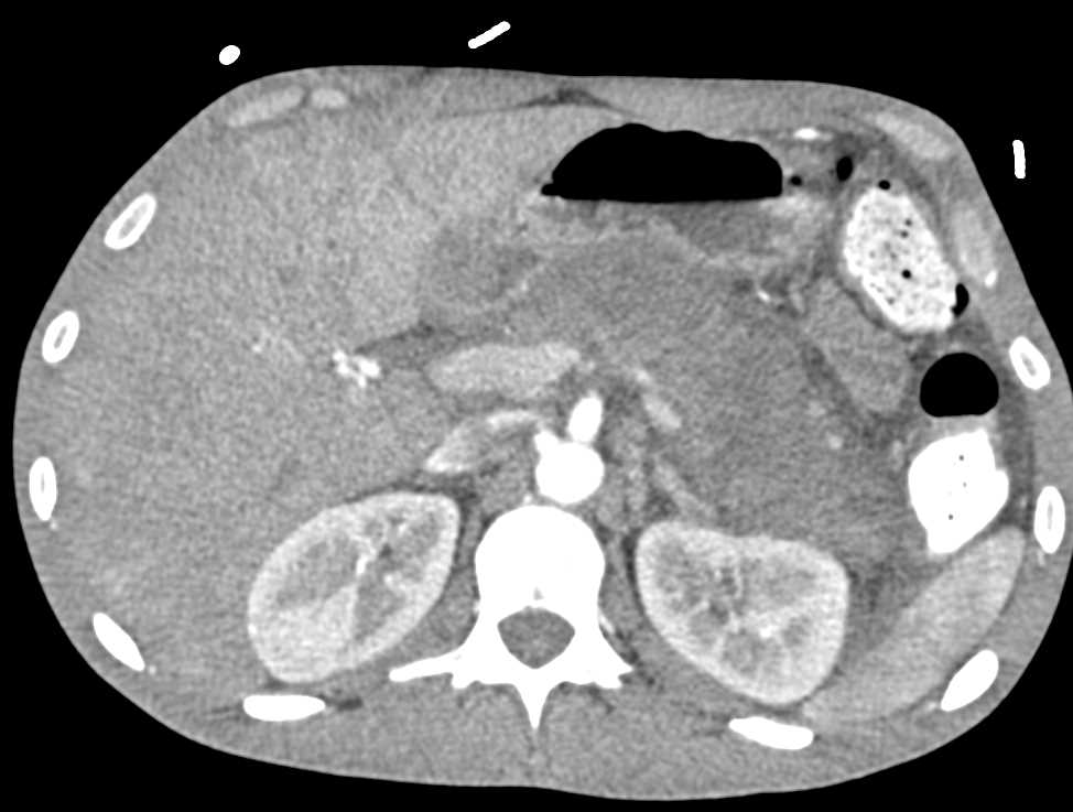 Large Duodenal Hematoma - CTisus CT Scan