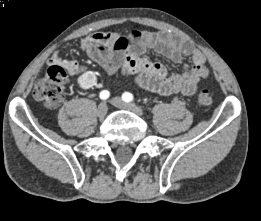 Small Bowel Carcinoid Tumor - CTisus CT Scan